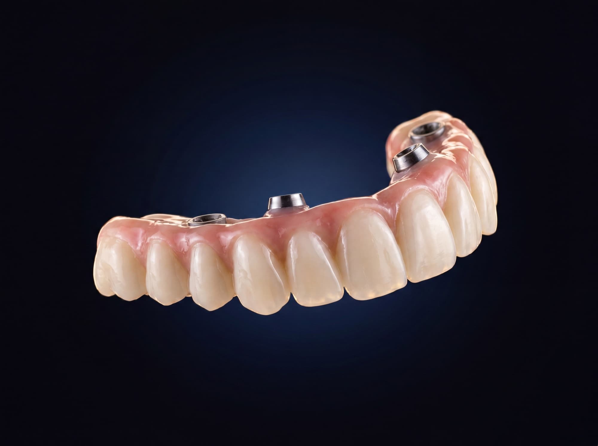 All-on-X cirkonio protezas — fiksuotas ant implantų